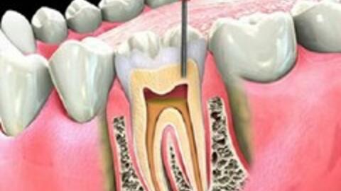 Điều trị viêm tuỷ răng: Khi nào phải lấy toàn bộ tuỷ?