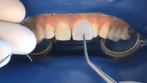 Quy trình dán sứ veneer: Đơn giản và ít phải mài hơn làm răng sứ, nhưng cũng 'khó nhằn' ra phết
