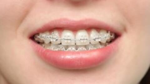 Niềng răng: Đâu là phương pháp hoàn hảo nhất cho bạn?