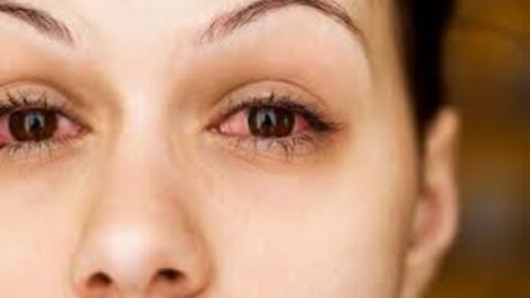 Đau mắt đỏ: Bệnh dễ gặp khi thời tiết sắp chuyển sang nóng bức