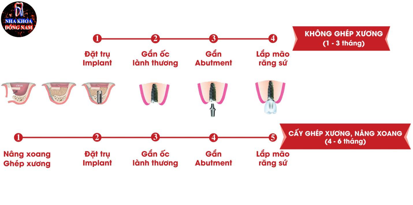 Tìm hiểu quy trình trồng răng Implant theo tiêu chuẩn 7 bước - ảnh 5 tim hieu quy trinh trong rang implant theo tieu chuan 7 buoc - anh 5