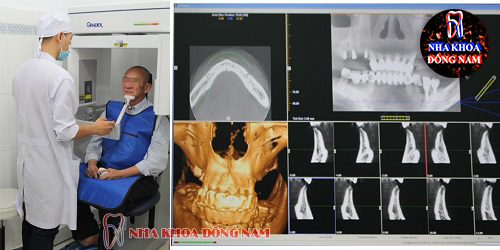 Tìm hiểu quy trình trồng răng Implant theo tiêu chuẩn 7 bước - ảnh 3 tim hieu quy trinh trong rang implant theo tieu chuan 7 buoc - anh 3